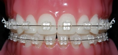 Les attaches orthodontiques transparentes