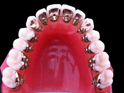 L’orthodontie linguale