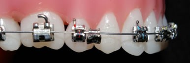 Urgence - Si un braket est décollé
